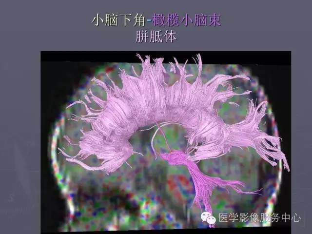 【PPT】小脑脚-磁共振DTI成像