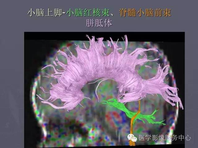 【PPT】小脑脚-磁共振DTI成像