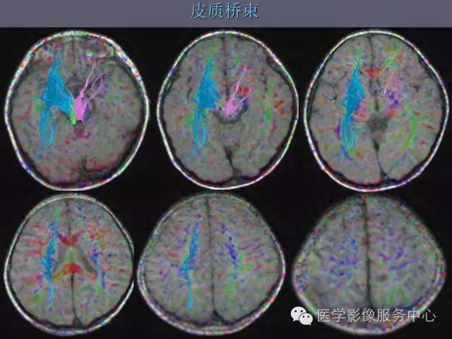 【PPT】小脑脚-磁共振DTI成像