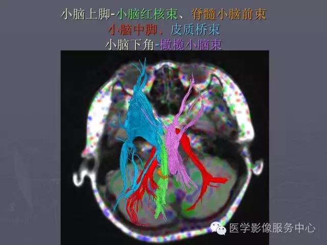 【PPT】小脑脚-磁共振DTI成像
