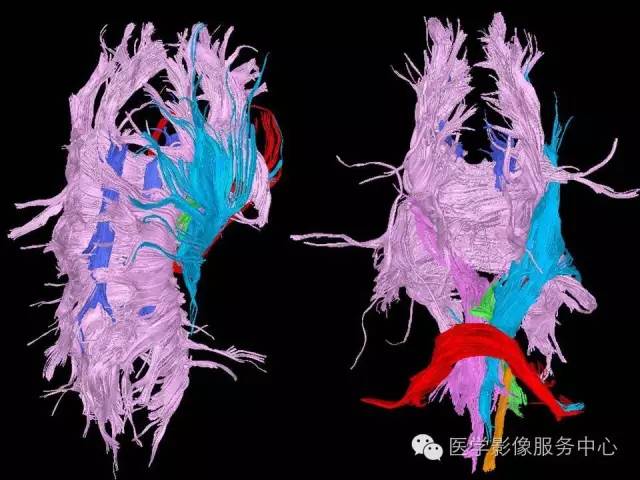 【PPT】小脑脚-磁共振DTI成像