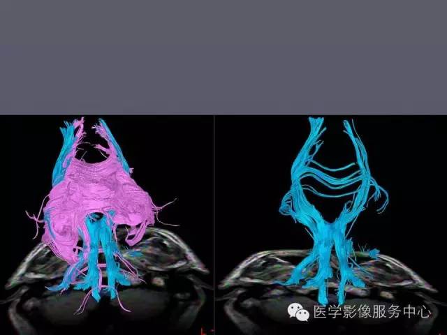 【PPT】小脑脚-磁共振DTI成像