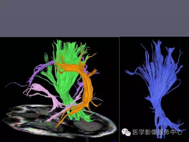 【PPT】小脑脚-磁共振DTI成像