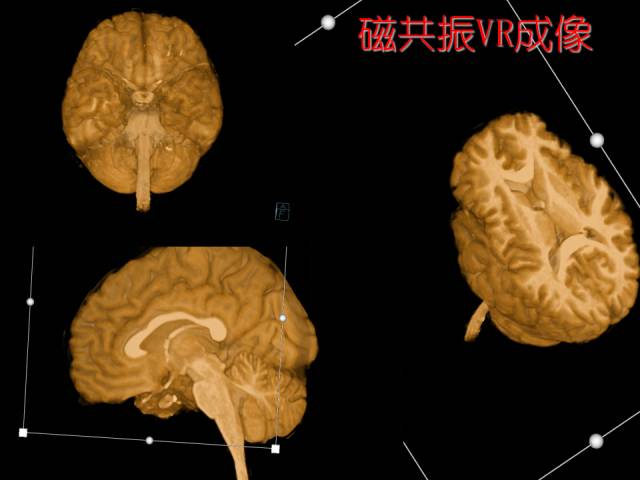 【PPT】扣带回、海马旁回的磁共振DTI成像