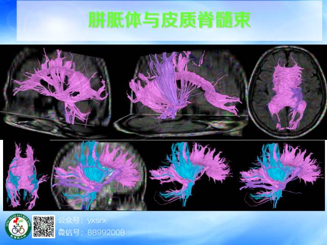 【PPT】扣带回、海马旁回的磁共振DTI成像