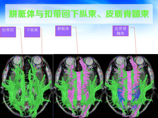 【PPT】扣带回、海马旁回的磁共振DTI成像
