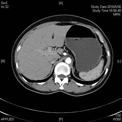 【病例】这位患者的胆囊哪去了？