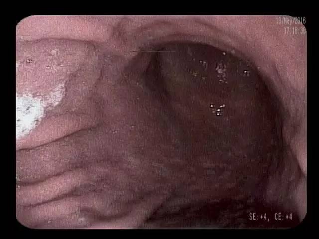 【病例】这位患者的胆囊哪去了? 【病例】这位患者的胆囊哪去了?