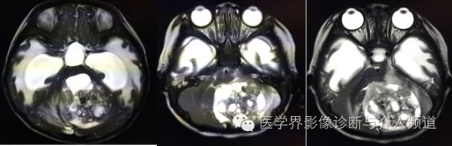 【病例】颅内畸胎瘤1例MR影像表现