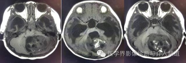 【病例】颅内畸胎瘤1例MR影像表现 【病例】颅内畸胎瘤1例MR影像表现