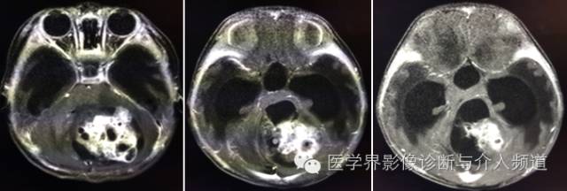 【病例】颅内畸胎瘤1例MR影像表现 【病例】颅内畸胎瘤1例MR影像表现