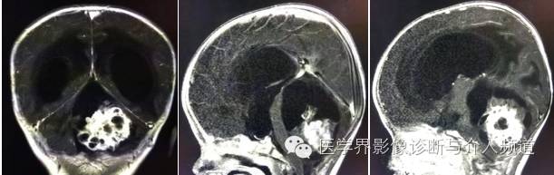 【病例】颅内畸胎瘤1例MR影像表现 【病例】颅内畸胎瘤1例MR影像表现