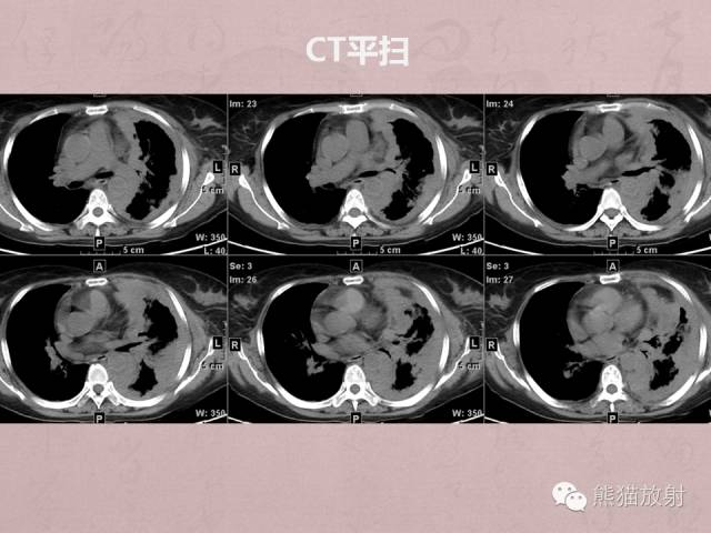 【病例】胸膜炎性肌纤维母细胞瘤1例CT影像表现