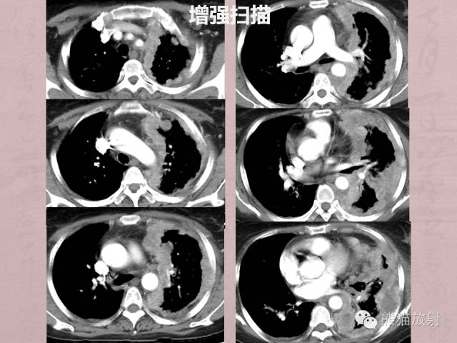 【病例】胸膜炎性肌纤维母细胞瘤1例CT影像表现