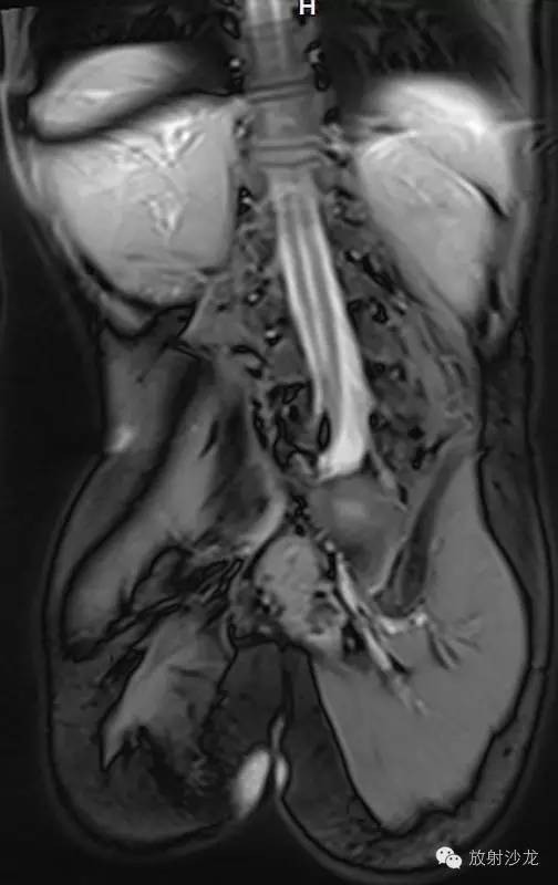 【病例】骶骨发育不全1例MR影像表现 【病例】骶骨发育不全1例MR影像表现