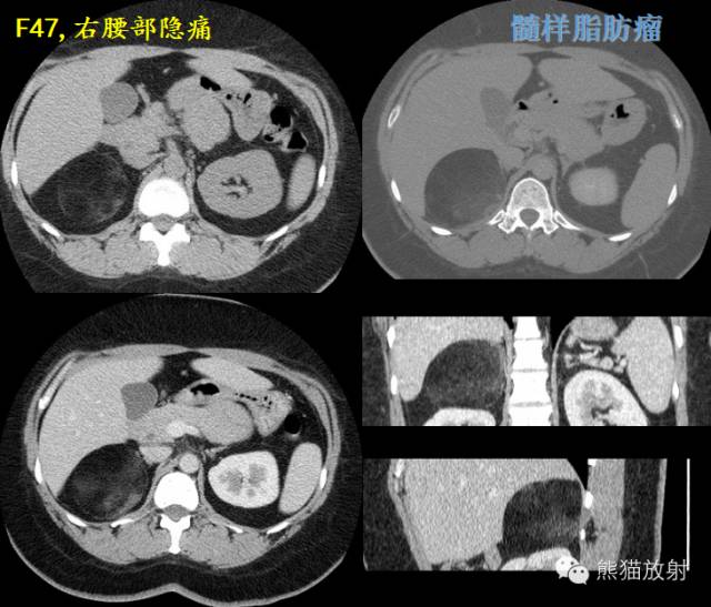 肾上腺含脂肿瘤 肾上腺含脂肿瘤