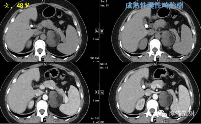 肾上腺含脂肿瘤 肾上腺含脂肿瘤
