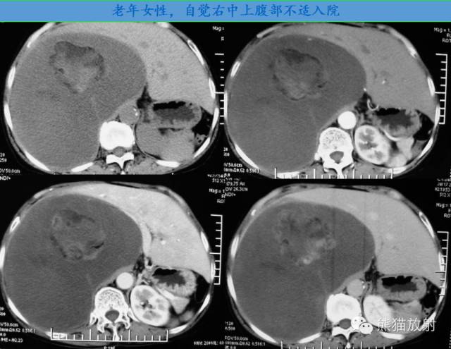 肾上腺含脂肿瘤 肾上腺含脂肿瘤