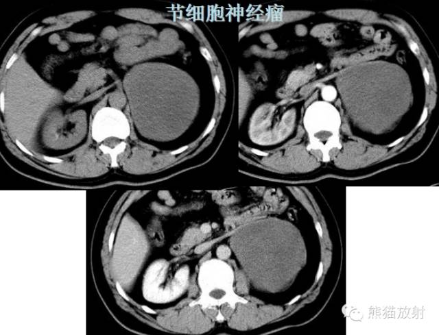 肾上腺含脂肿瘤 肾上腺含脂肿瘤