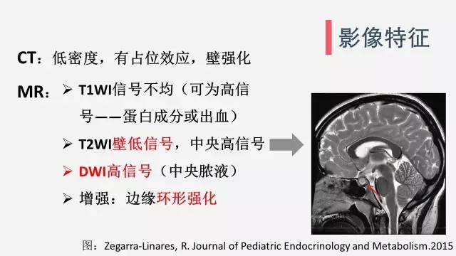 【病例】垂体脓肿1例CT及MR影像表现