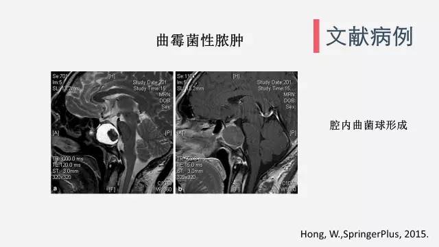 【病例】垂体脓肿1例CT及MR影像表现