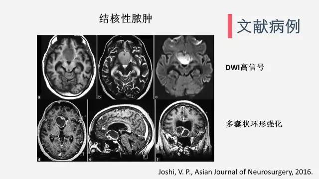 【病例】垂体脓肿1例CT及MR影像表现