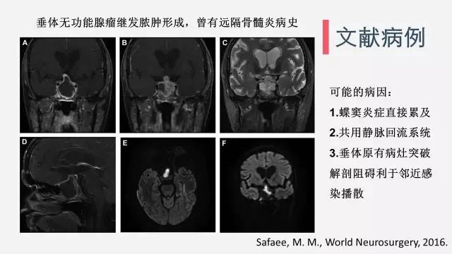 【病例】垂体脓肿1例CT及MR影像表现