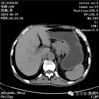 【病例】肠系膜淋巴瘤1例CT影像表现