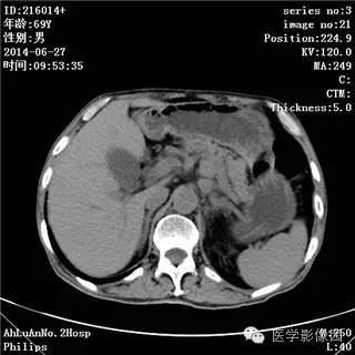 【病例】肠系膜淋巴瘤1例CT影像表现