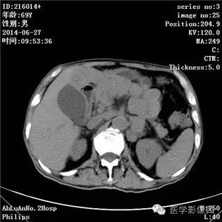 【病例】肠系膜淋巴瘤1例CT影像表现