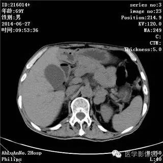 【病例】肠系膜淋巴瘤1例CT影像表现