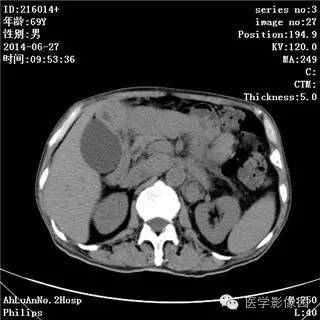 【病例】肠系膜淋巴瘤1例CT影像表现