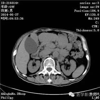【病例】肠系膜淋巴瘤1例CT影像表现