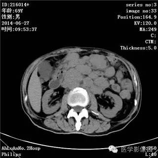 【病例】肠系膜淋巴瘤1例CT影像表现