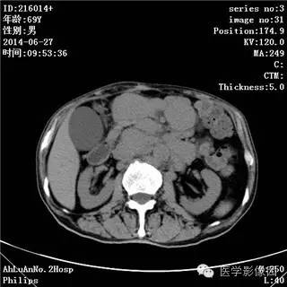 【病例】肠系膜淋巴瘤1例CT影像表现
