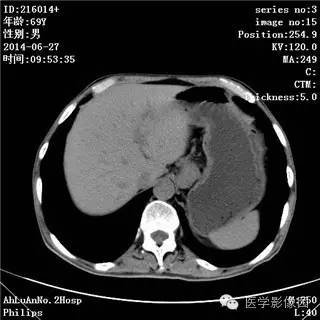 【病例】肠系膜淋巴瘤1例CT影像表现