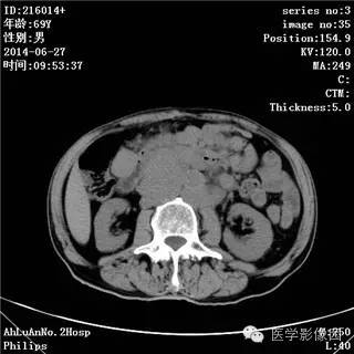 【病例】肠系膜淋巴瘤1例CT影像表现