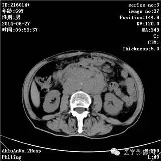【病例】肠系膜淋巴瘤1例CT影像表现