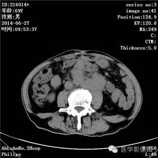 【病例】肠系膜淋巴瘤1例CT影像表现