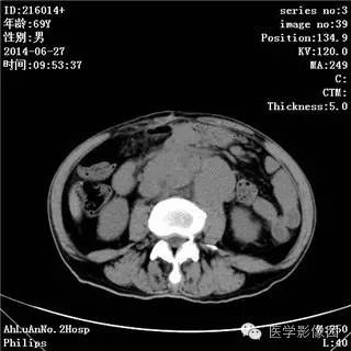 【病例】肠系膜淋巴瘤1例CT影像表现