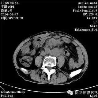 【病例】肠系膜淋巴瘤1例CT影像表现