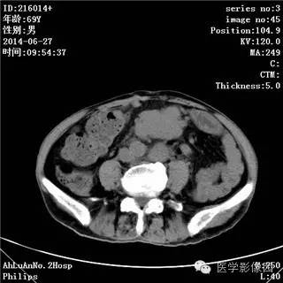 【病例】肠系膜淋巴瘤1例CT影像表现