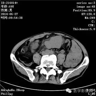 【病例】肠系膜淋巴瘤1例CT影像表现