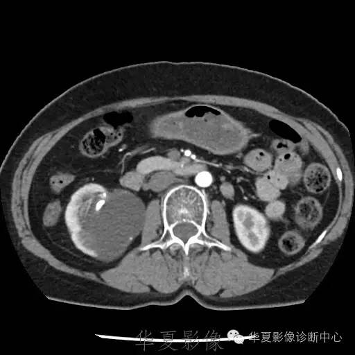 【病例】肾盂旁囊肿1例——CTU让你更清楚的认识这个疾病 【病例】肾盂旁囊肿1例——CTU让你更清楚的认识这个疾病