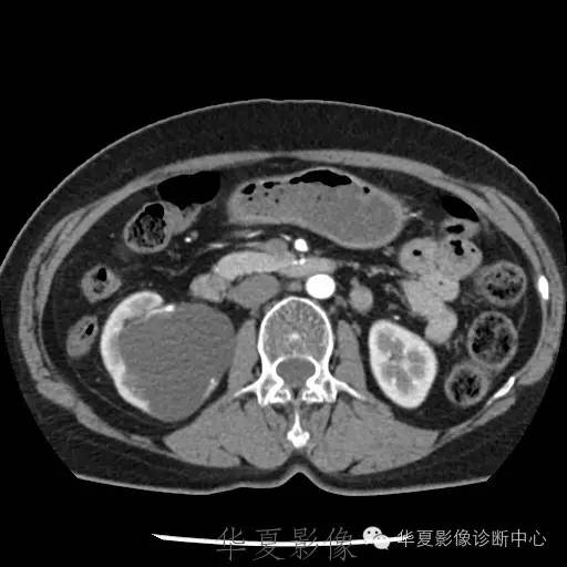 【病例】肾盂旁囊肿1例——CTU让你更清楚的认识这个疾病 【病例】肾盂旁囊肿1例——CTU让你更清楚的认识这个疾病