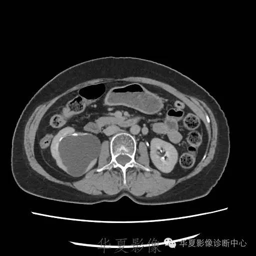 【病例】肾盂旁囊肿1例——CTU让你更清楚的认识这个疾病 【病例】肾盂旁囊肿1例——CTU让你更清楚的认识这个疾病