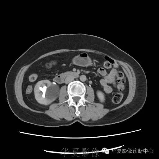【病例】肾盂旁囊肿1例——CTU让你更清楚的认识这个疾病 【病例】肾盂旁囊肿1例——CTU让你更清楚的认识这个疾病