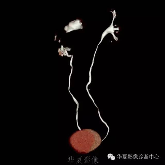 【病例】肾盂旁囊肿1例——CTU让你更清楚的认识这个疾病 【病例】肾盂旁囊肿1例——CTU让你更清楚的认识这个疾病