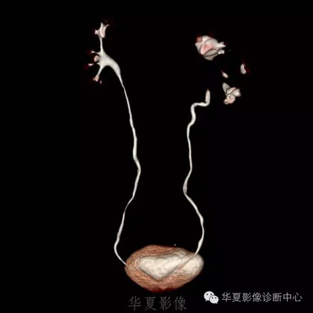 【病例】肾盂旁囊肿1例——CTU让你更清楚的认识这个疾病 【病例】肾盂旁囊肿1例——CTU让你更清楚的认识这个疾病
