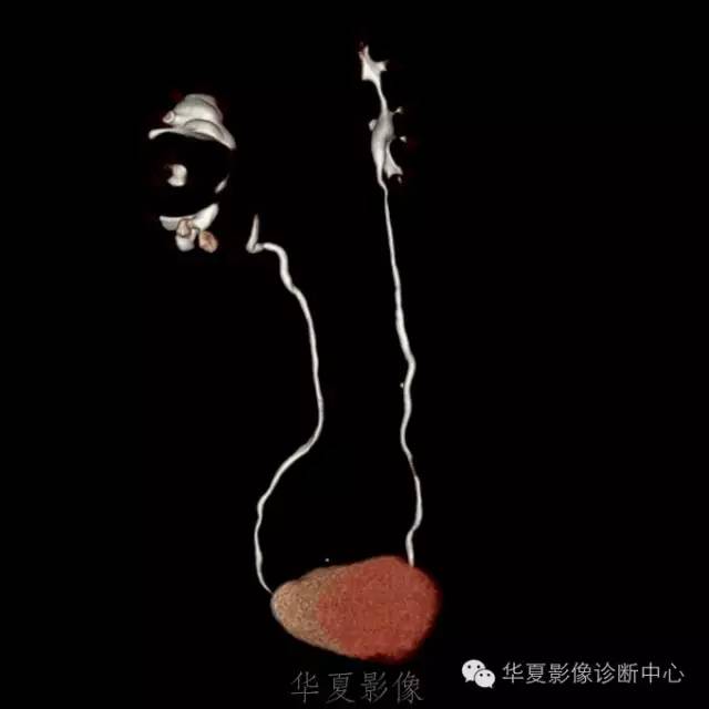 【病例】肾盂旁囊肿1例——CTU让你更清楚的认识这个疾病 【病例】肾盂旁囊肿1例——CTU让你更清楚的认识这个疾病